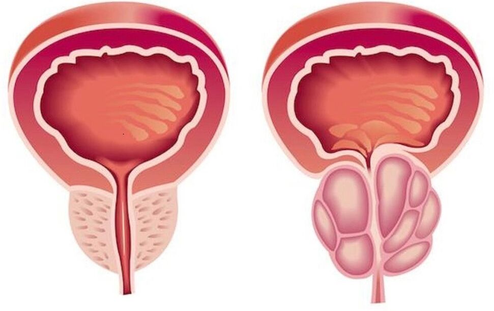 প্রোস্টাটাইটিস সহ স্বাস্থ্যকর এবং স্ফীত প্রোস্টেট